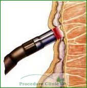 Infrared Coagulation